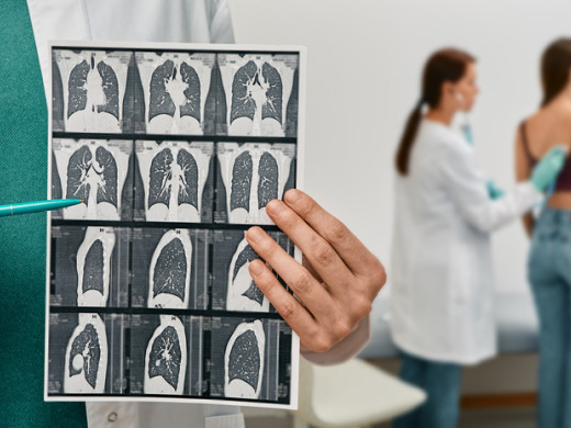 Jizvení plic je třeba léčit včas, varují pneumologové
