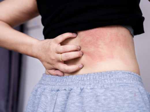 Rizika chronické kopřivky po infekci SARSCoV-2: binárodní populační kohortové studie z Jižní Koreje a Japonska