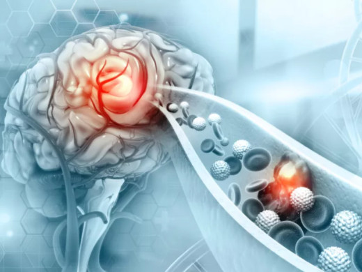 Následná péče po CMP: změna popelky v princeznu
