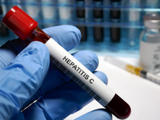 Co trápí tisíce českých jater? Žloutenka typu C