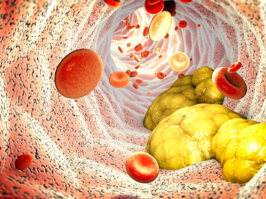 Covid aterosklerózu nezastaví