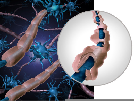 O demyelinizačních onemocněních virtuálně