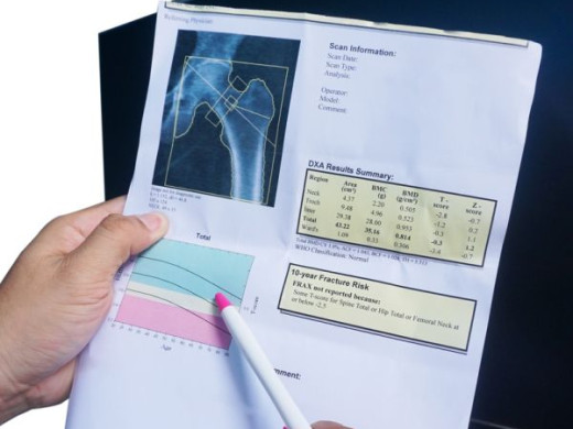 Osteoporóza – diagnostika a léčba