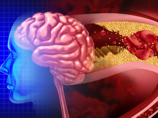 Hypertenze a poškození CNS