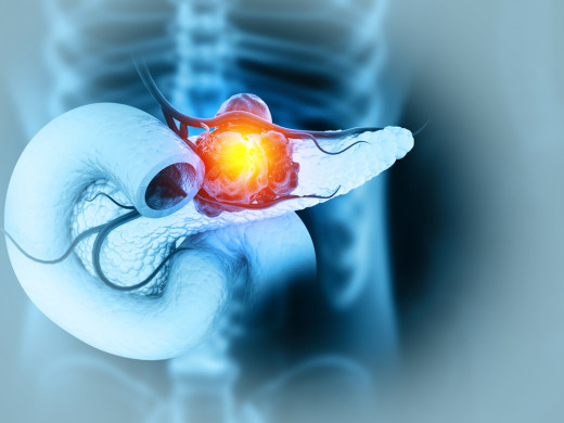 Včasné odhalení rakoviny slinivky zachrání či prodlouží život