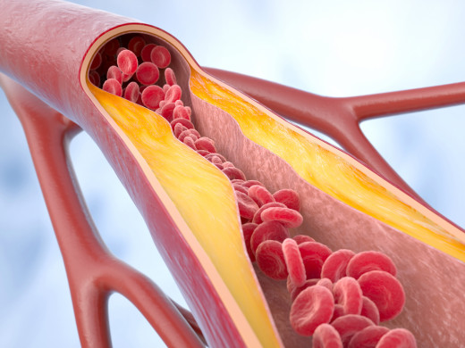 Vaskulární dávka rivaroxabanu v kombinaci s ASA: nejlepší volba pro nemocné s chronickými formami aterosklerózy