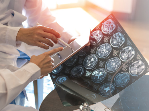 Lékaři zkoumají, jak zastavit roztroušenou sklerózu