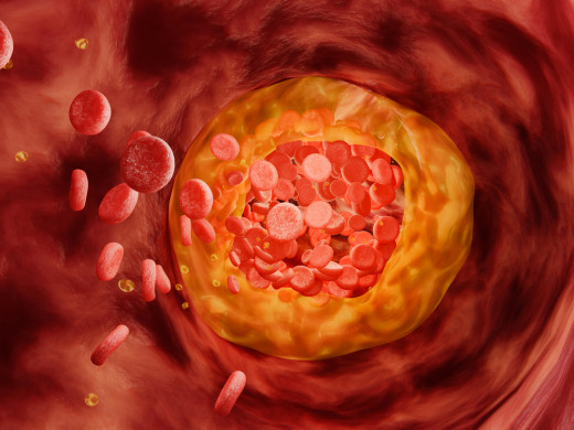 Aterotrombóza ako príčina akútnych komplikácií aterosklerózy a ako sa jej dá efektívne a bezpečne predchádzať