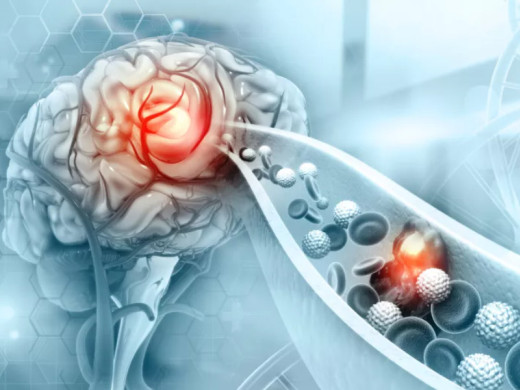 Onemocnění periferních tepen je u žen nedostatečně diagnostikováno a léčeno