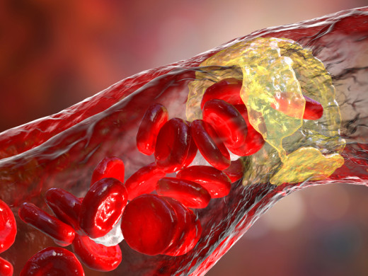 Možnosti sekundární prevence ICHS a periferní aterosklerózy