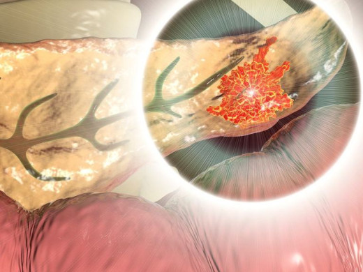 Pacienti s rakovinou slinivky mohou žít násobně déle