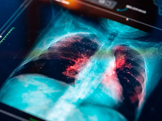 Rakovina plic bují rychle – počítá se každý týden