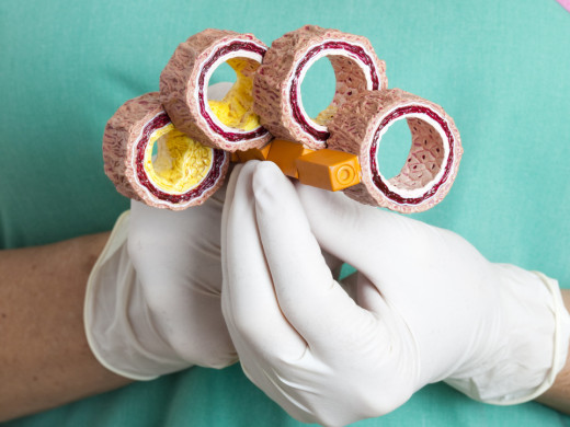 Jak se mění léčba hyperlipidemií s věkem?