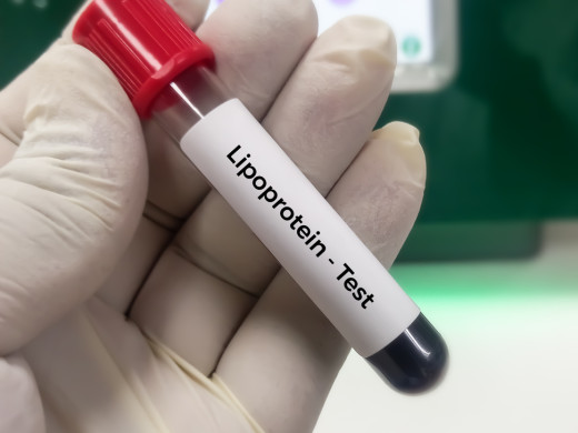 Extrémní elevace koncentrací Lp (a) – klinické dopady a co z nich vyplývá?