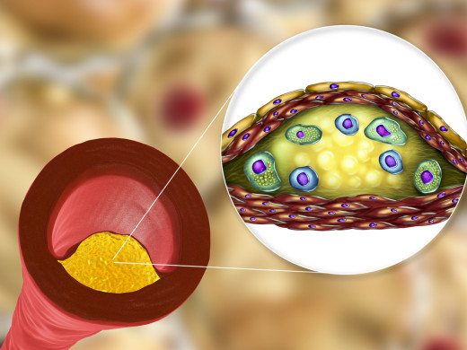Co ovlivňuje tuhost cévní stěny u starších diabetiků 2. typu?